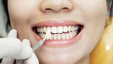 Carillas Dentales en Barcelona Sants