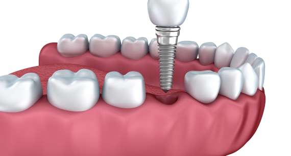 Ventajas de los implantes dentales